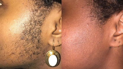 Hair removal oil