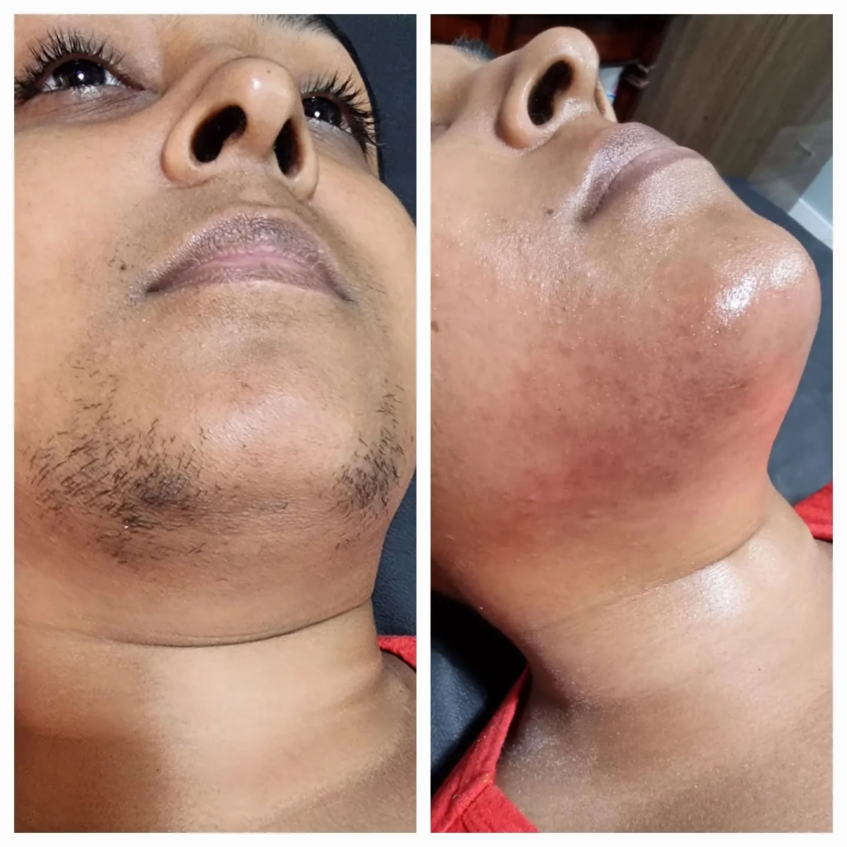 Hair removal oil