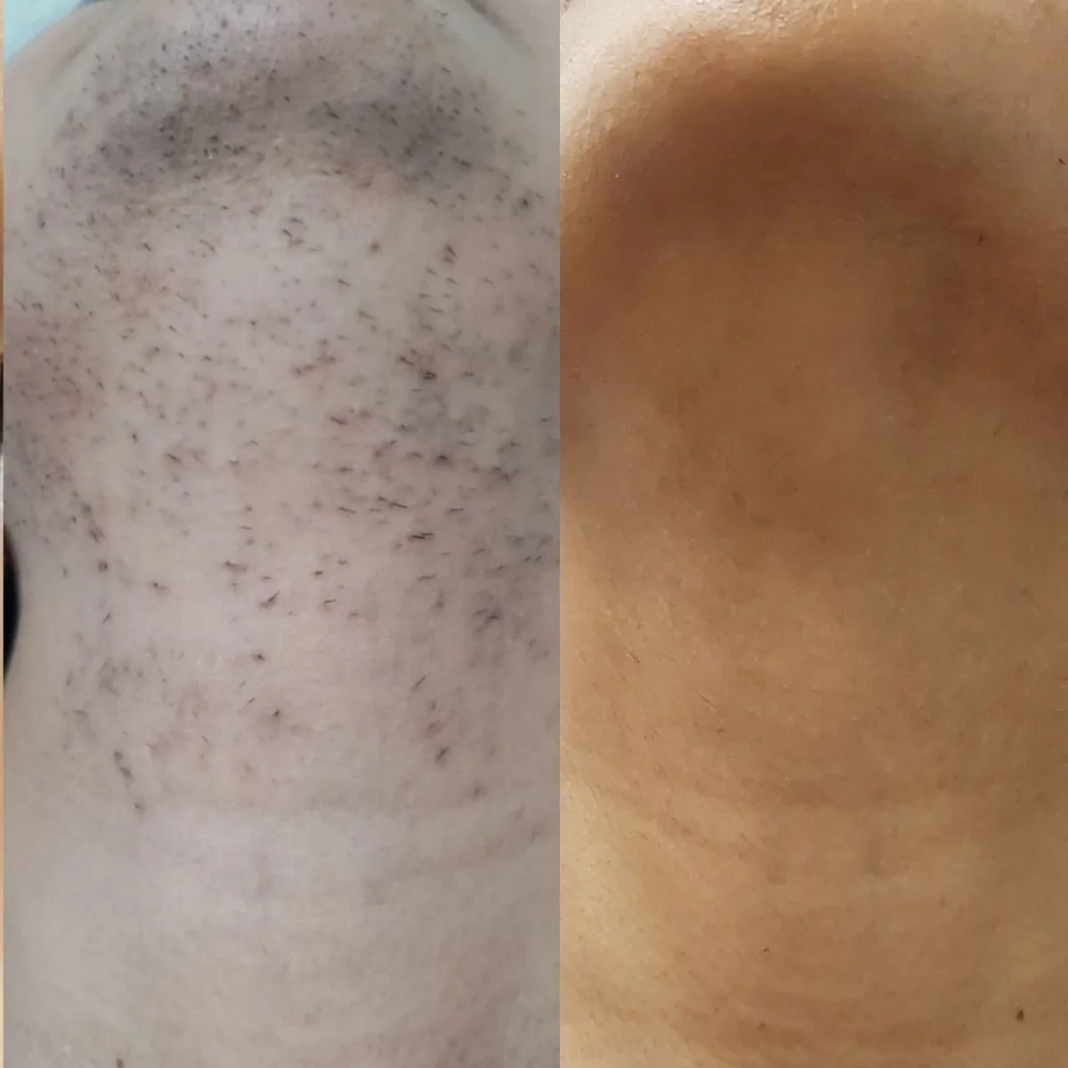 Hair removal oil