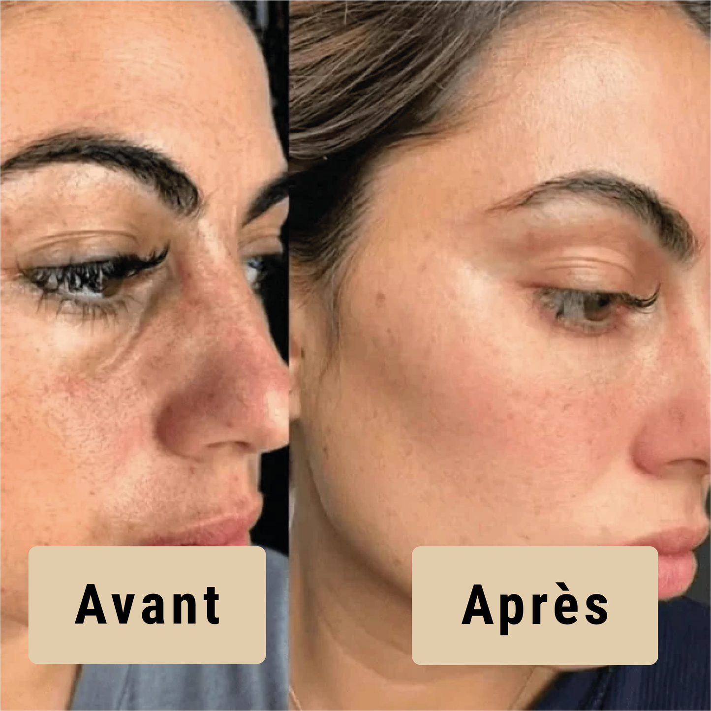 Satineva® | Peel Shot coréen – Élimine les impuretés et sublime la peau